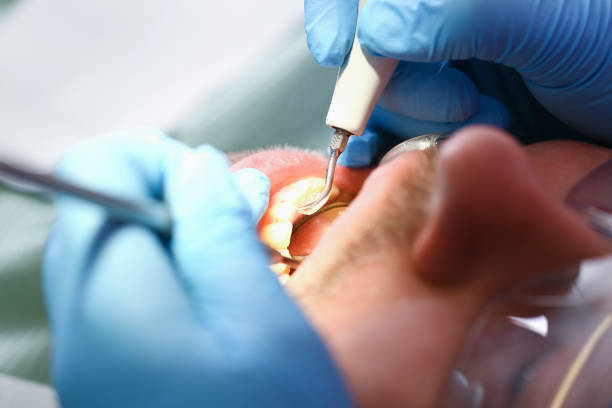 Best Knocked-Out Tooth (Avulsed Tooth) Treatment in Noble, OK